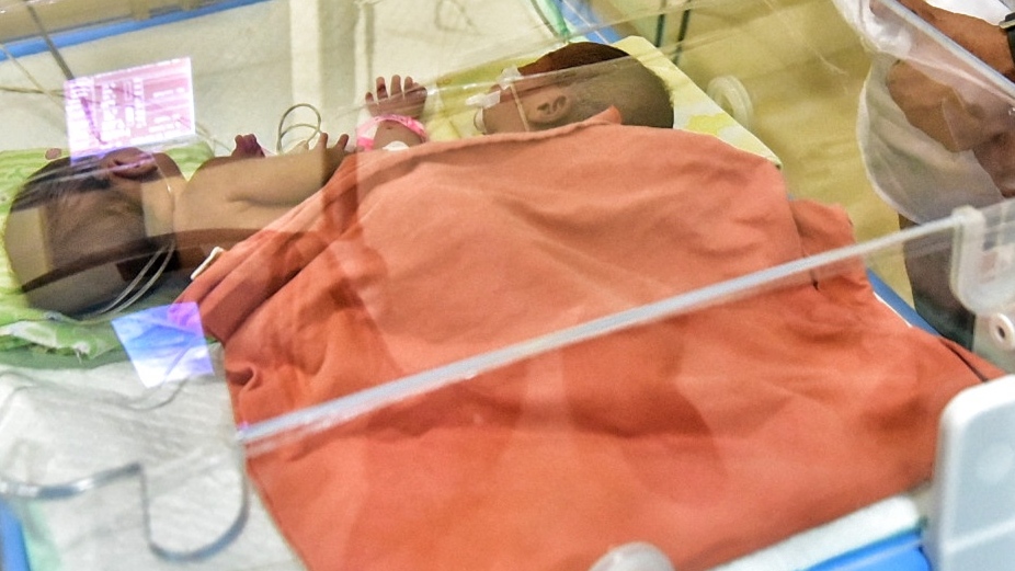  Kembar siam Ratih dan Ririn dalam perawatan Rumah Sakit Umum Pusat Haji Adam Malik (RSUP HAM), Medan.