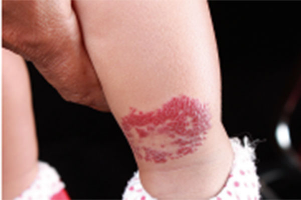 Hemangioma infantil di kaki. 
