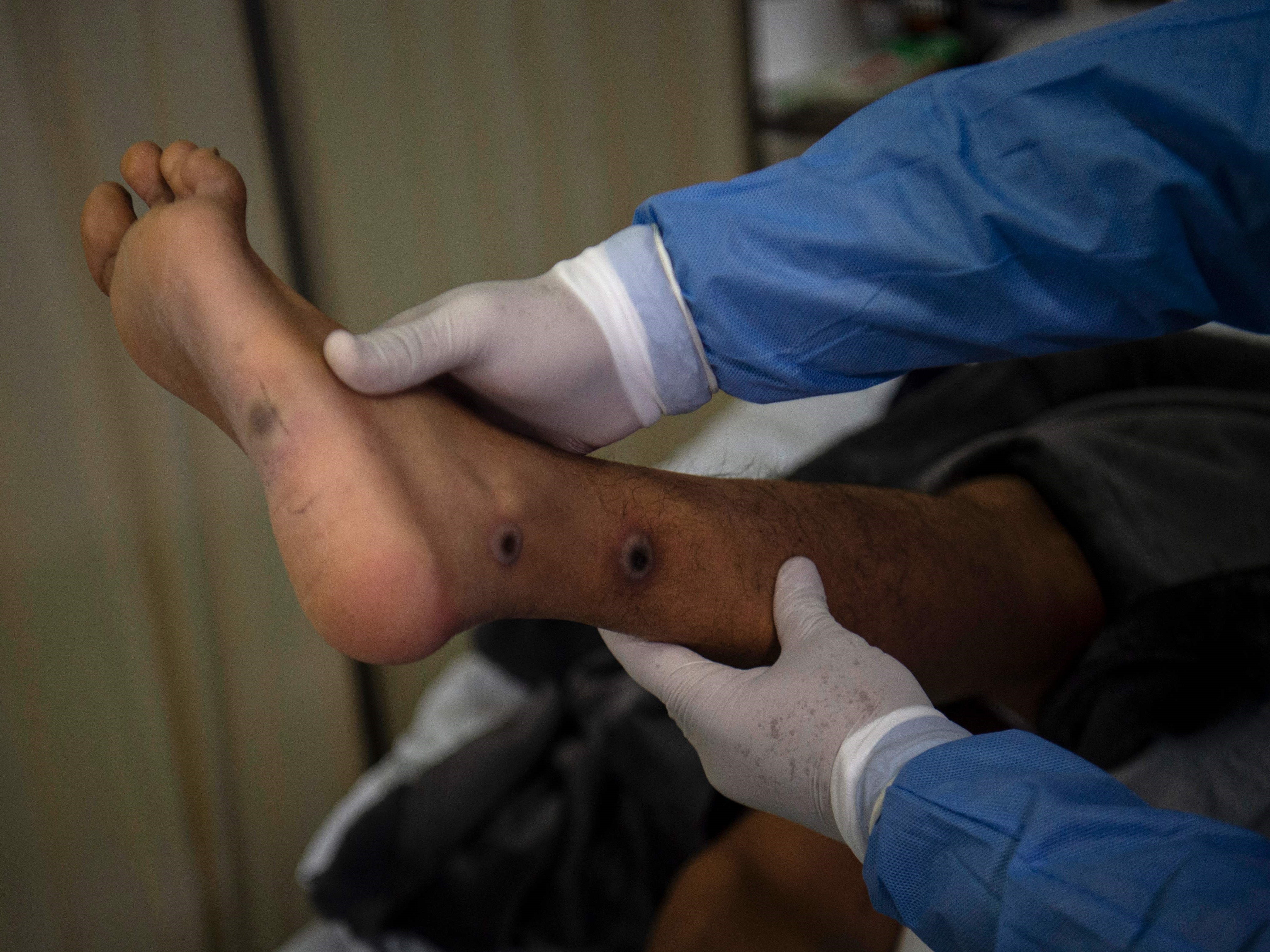 Dokter memeriksa pasien dengan luka akibat infeksi cacar monyet di ruang isolasi pasien cacar monyet di RS Arzobispo Loayza, Lima, Peru.