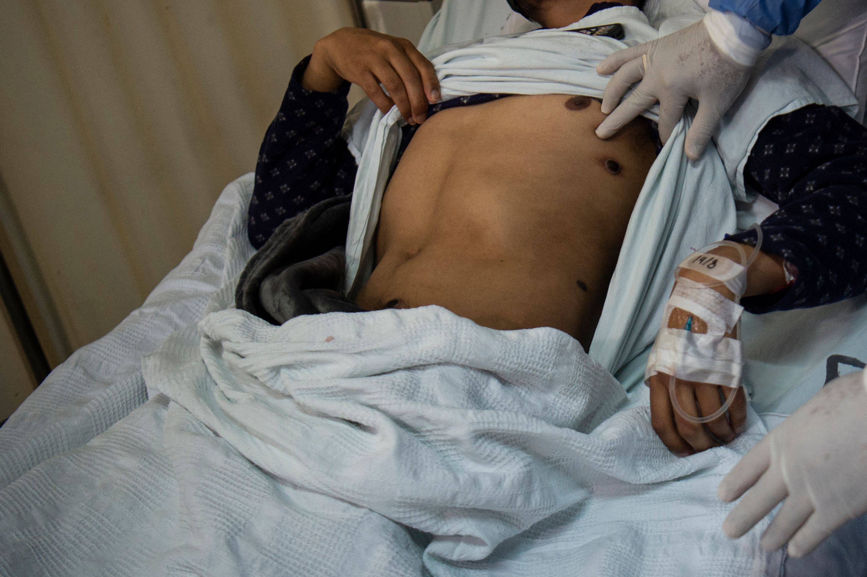 Seorang dokter memeriksa pasien terinfeksi cacar monyet di ruang isolasi pasien cacar monyet di Rumah Sakit Arzobispo Loayza, Lima, Peru.