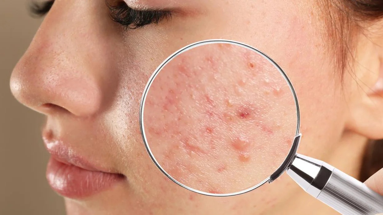 'Acne fighter' terus menggali informasi tentang skincare yang dapat menghilangkan jerawat sekaligus mencerahkan wajah.