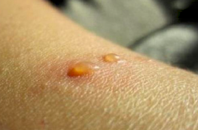 Pakar Ingatkan 5 Hal baru Tentang Cacar Monyet yang Perlu Diketahui