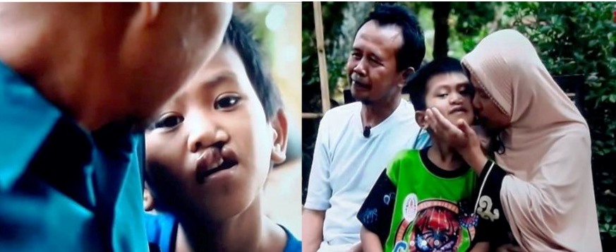 Sebelum operasi (kiri) dan setelah operasi.