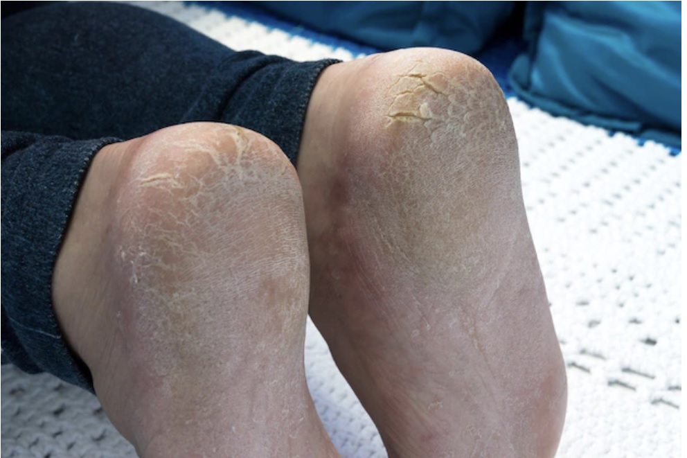 Ilustrasi kaki pecah-pecah