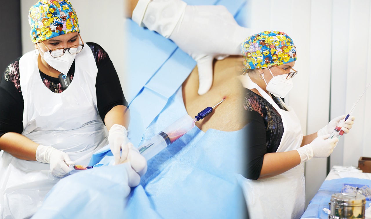 Ilustrasi prosedur mini lopsuction atau sedot lemak