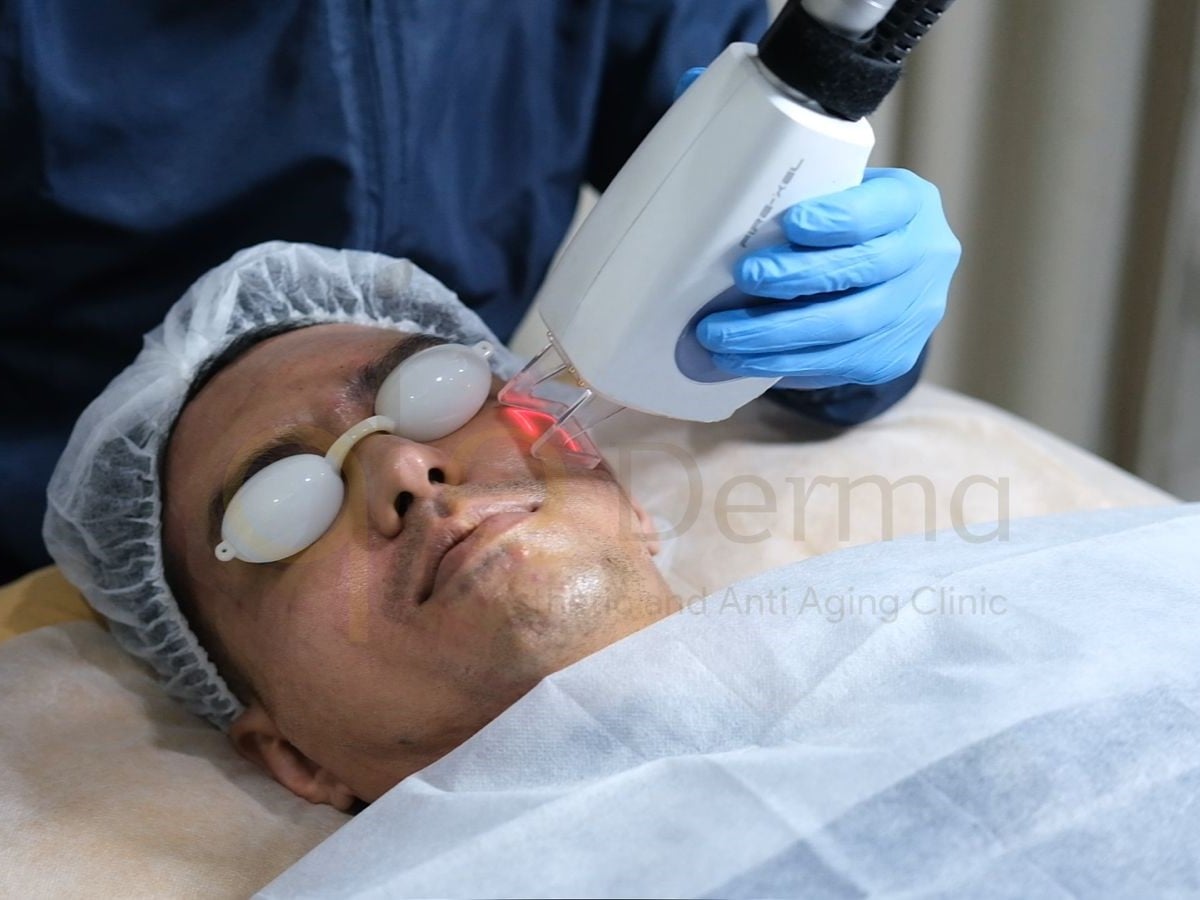 Ilustrasi pasien yang menjalani laser CO2 fractional.