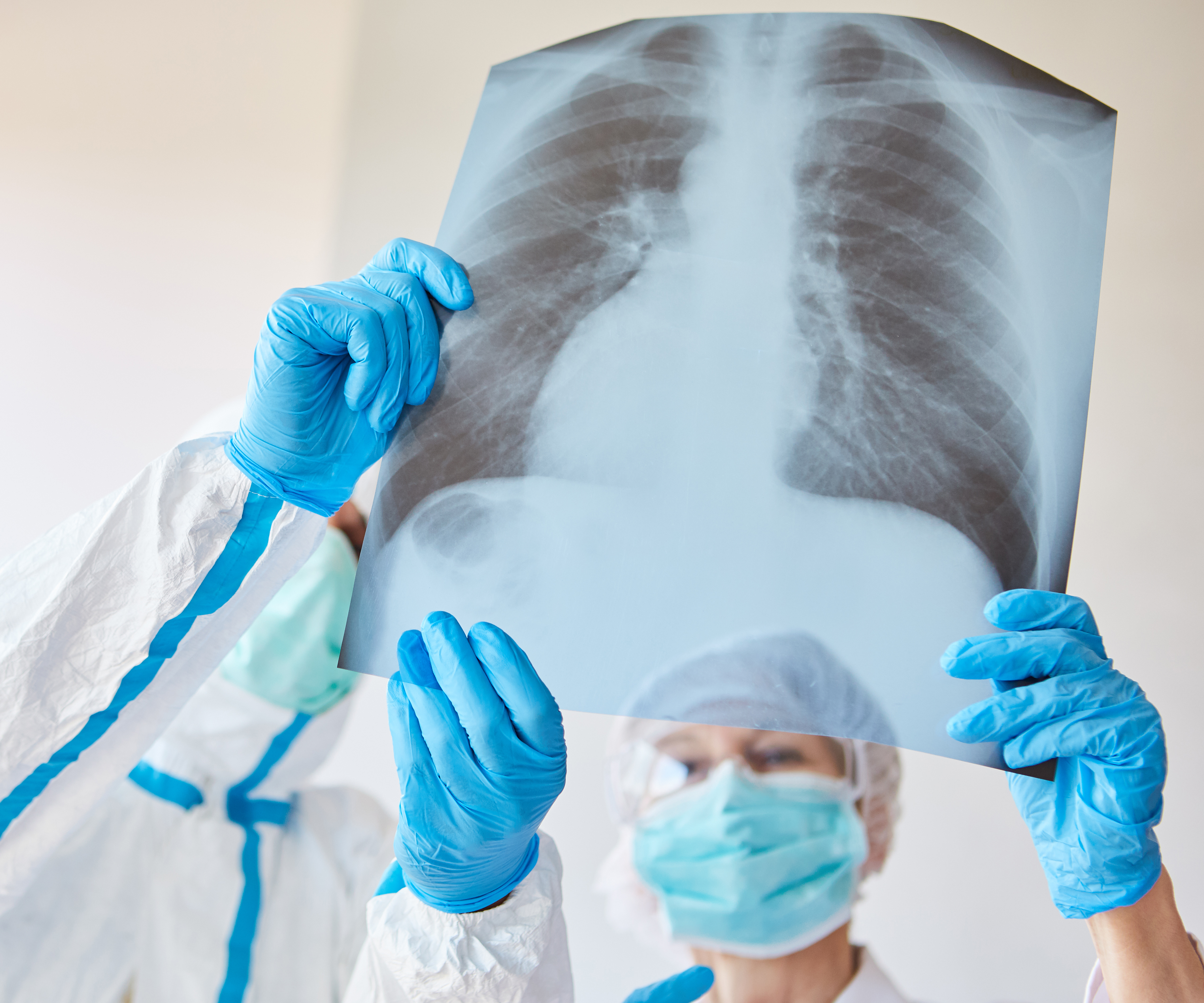 Kenali Tanda Anak Kena Pneumonia