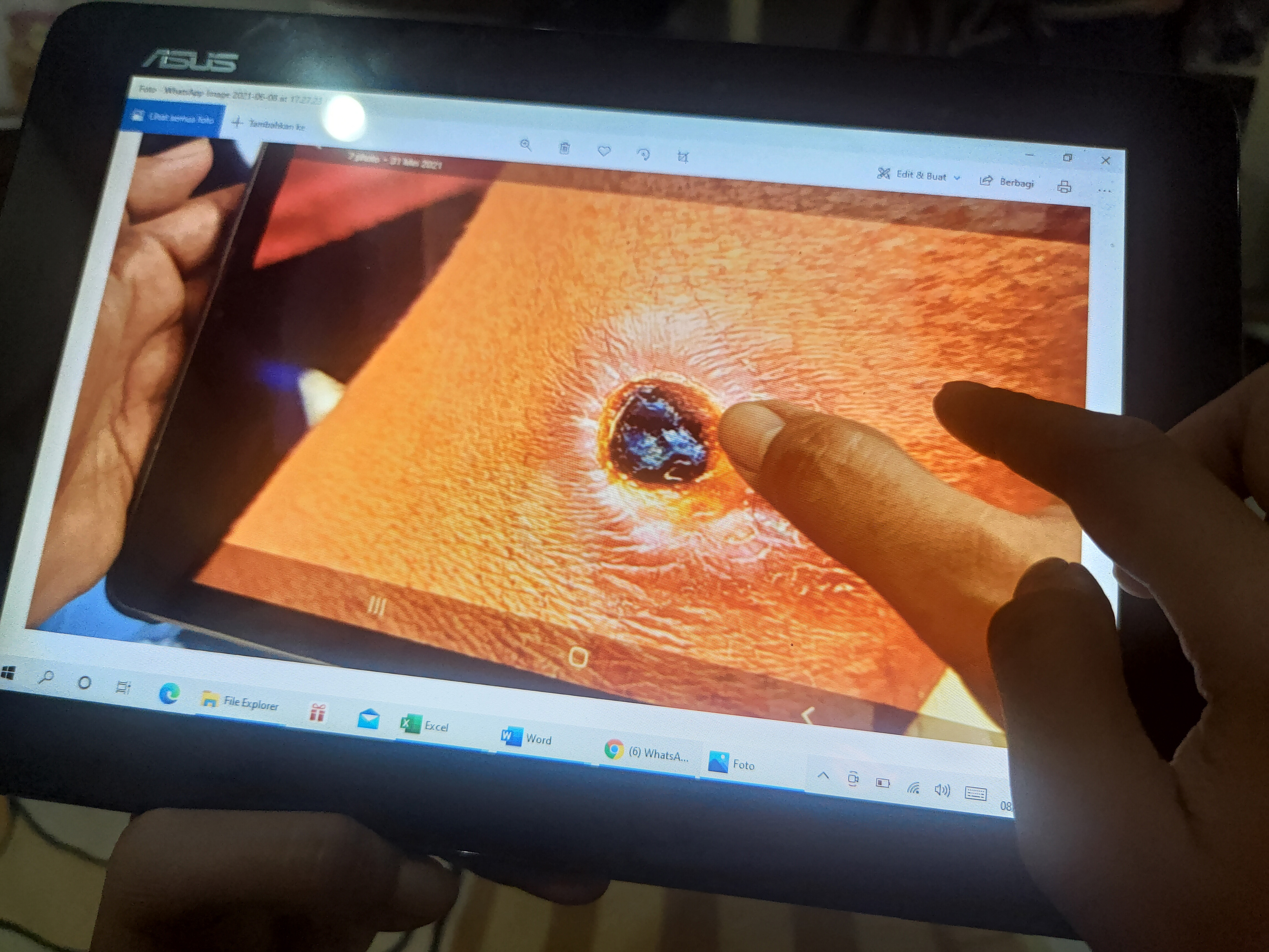  Petugas menunjukkan foto infeksi kulit manusia akibat terkena antraks.