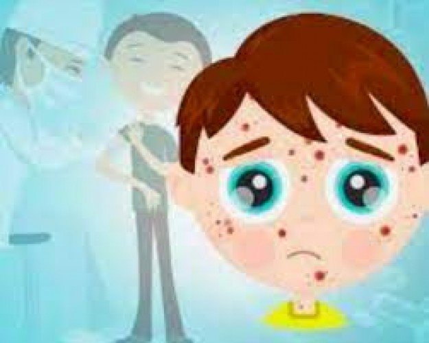 Campak Tingkatkan Risiko Infeksi karena Turunkan Antibodi