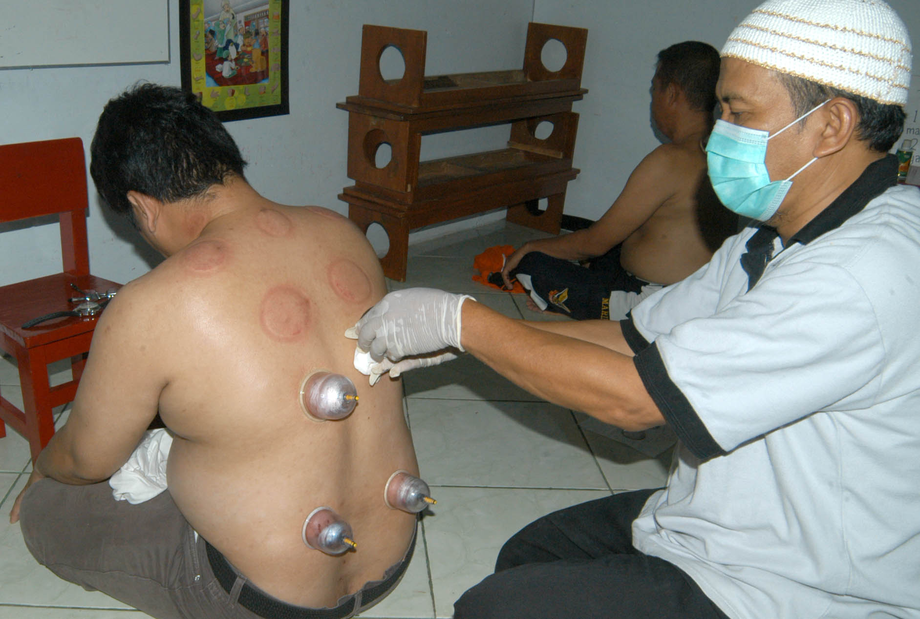 Seorang ahli pengobatan bekam mengobati pasien di Rangkapan Jaya Baru, Depok, Jabar.