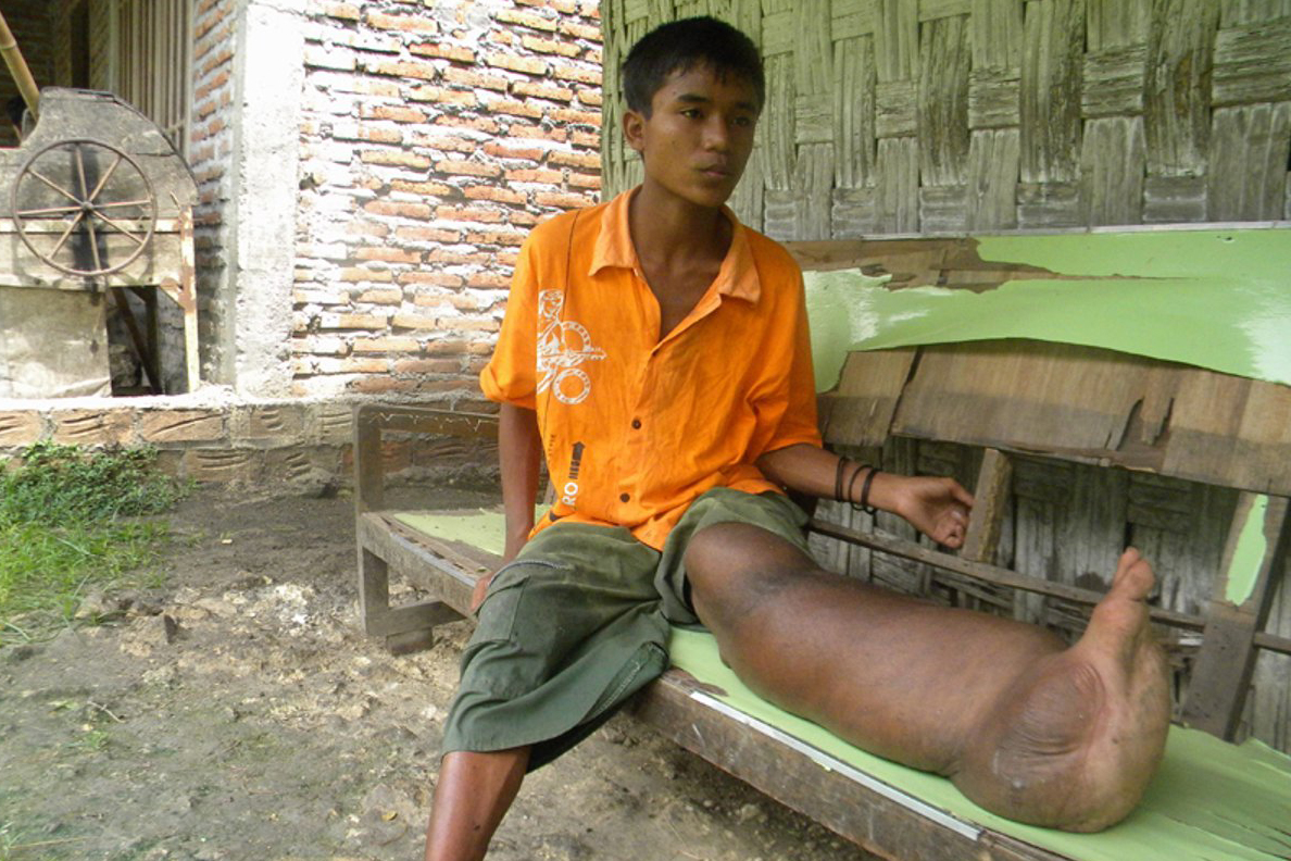 Penderita penyakit filariasis atau kaki gajah di Kabupaten Bojonegoro, Jawa Tengah. 