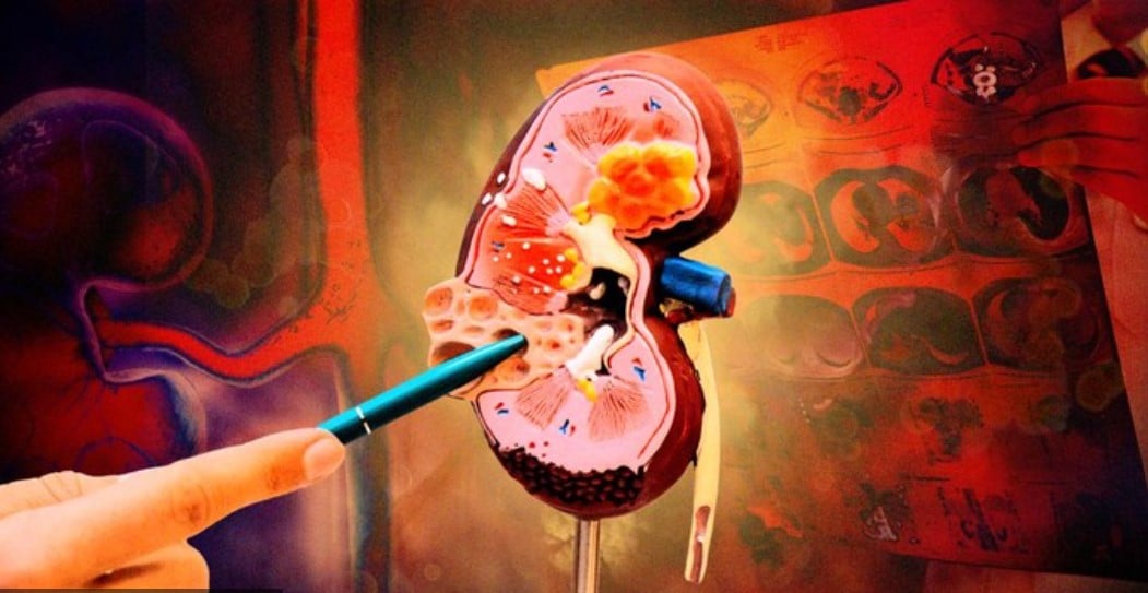 Kemenkes Kembali Temukan Kasus Gagal Ginjal pada Anak