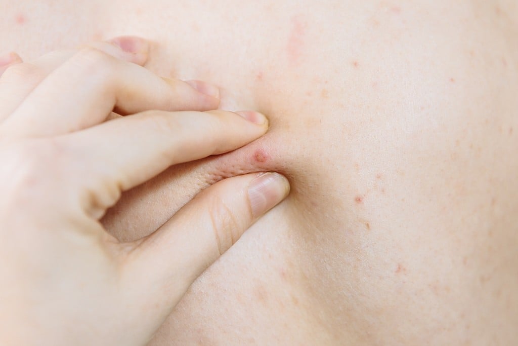 Ilustrasi jerawat punggung