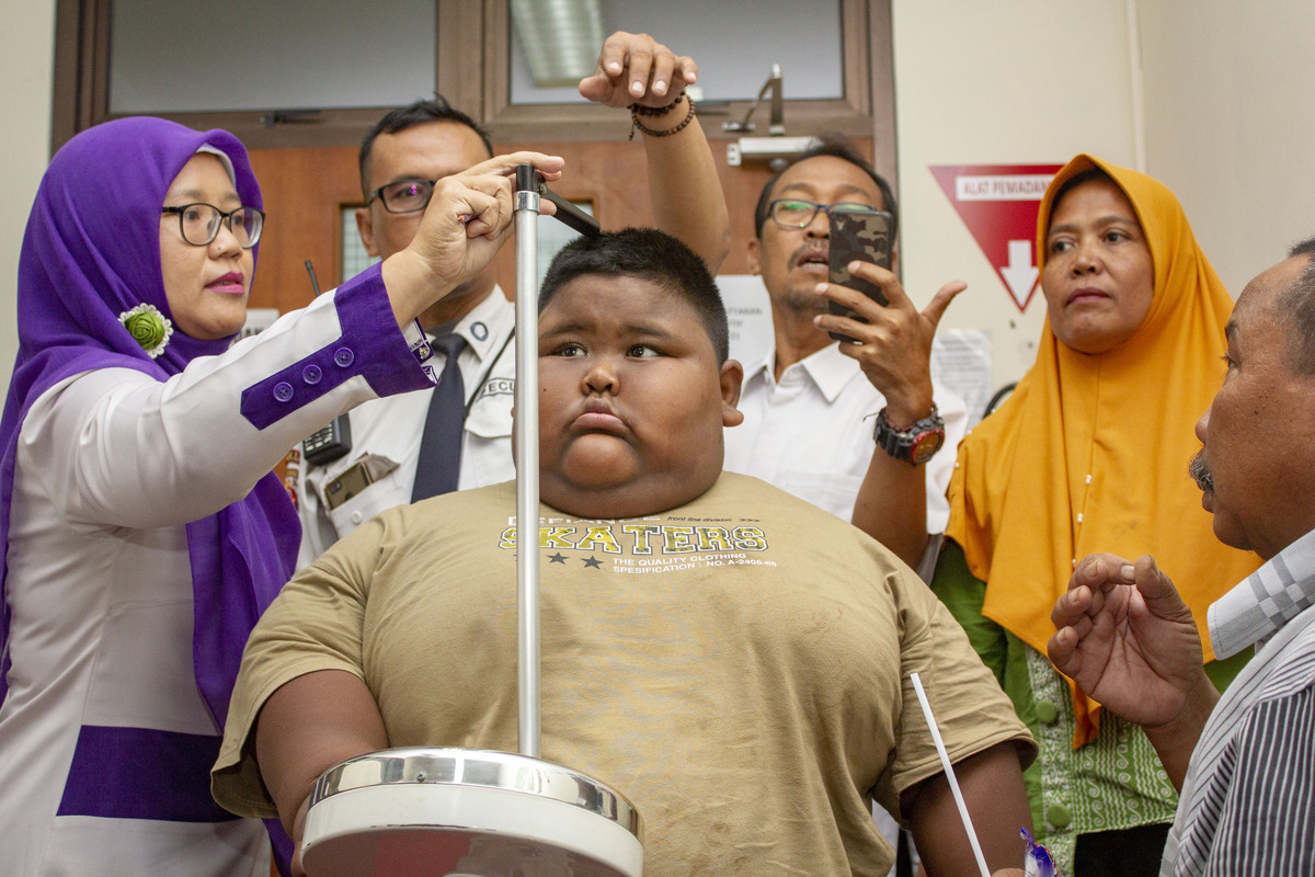 Satia Putra (7) anak penyandang obesitas dengan berat badan mencapai 101 kilogram