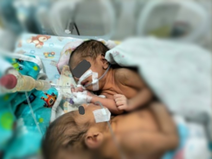 Bayi kembar siam terbaring dalam inkubator di RSUD dr Hendrikus Fernandes, Larantuka, NTT.