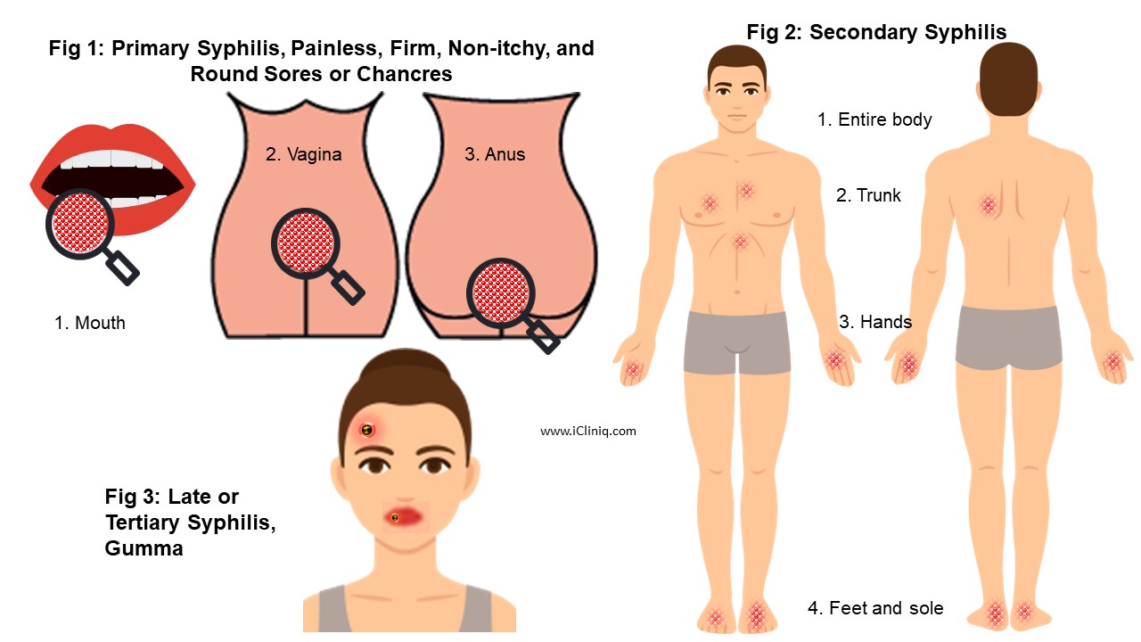 Ilustrasi gejala sifilis.