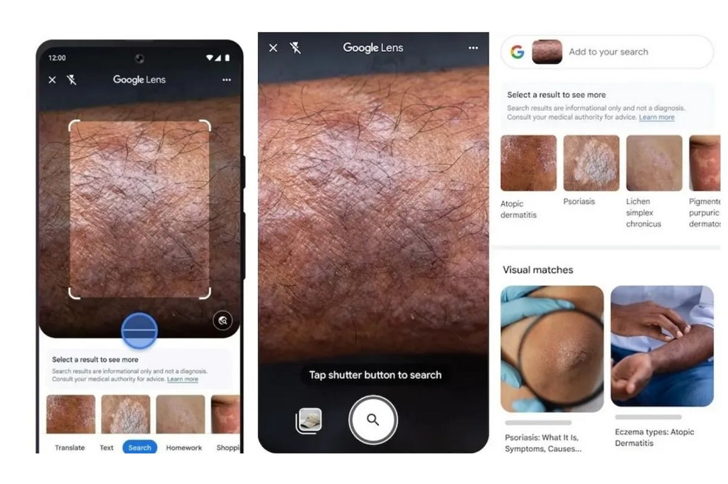 Google Lens yang terintegrasi pada aplikasi di iOS dan Android dapat melakukan pencarian terkait kondisi kulit.