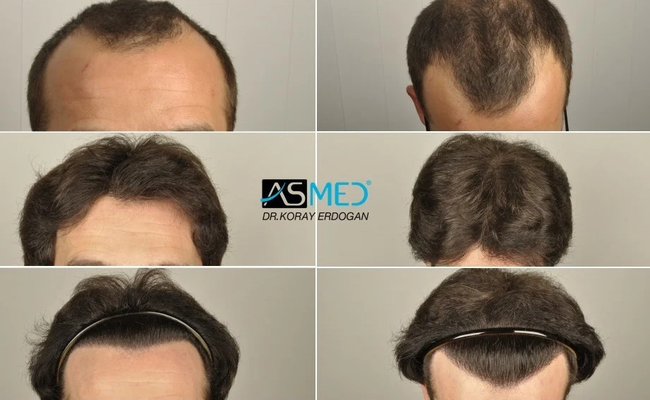 ilustrasi hasil prosedur transplantasi rambut.