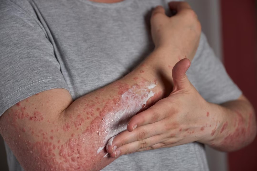 Awas, Psoriasis Bisa Dipicu Stres dan Cuaca