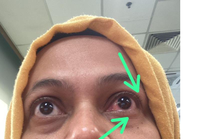 Kondisi mata korban penganiayaan.