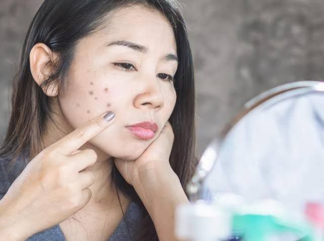 9 Cara Menghilangkan Flek Hitam di Wajah yang Membandel