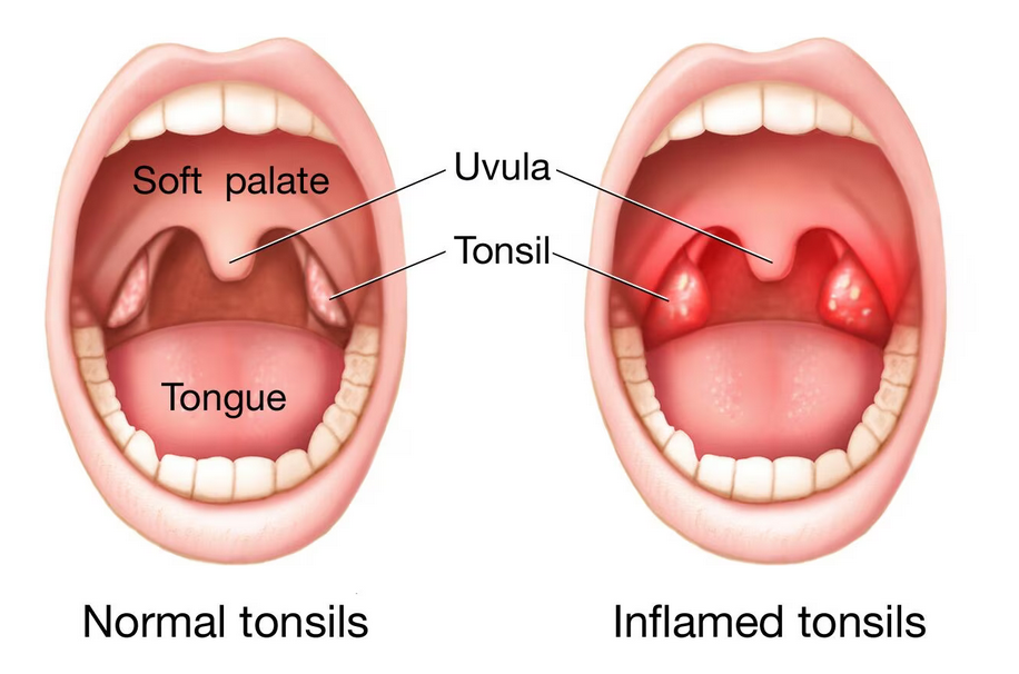 Tonsilitis atau radang amandel.