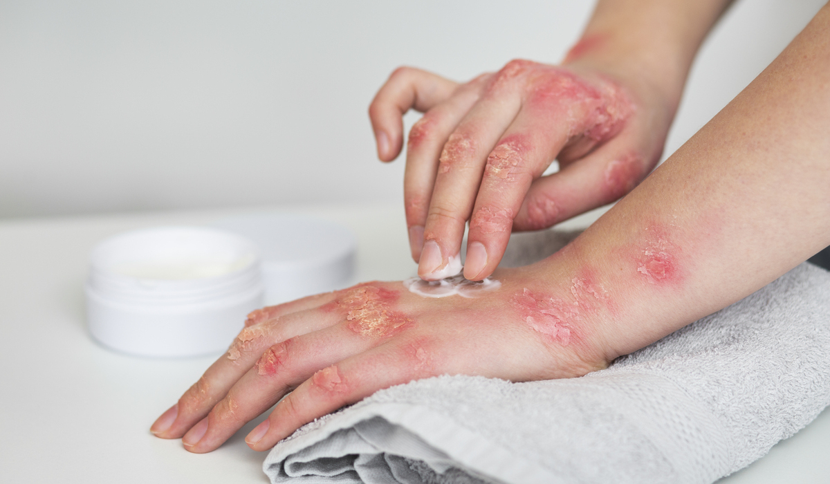 Ilustrasi pasien penderita cacar monyet atau monkey pox/Mpox.