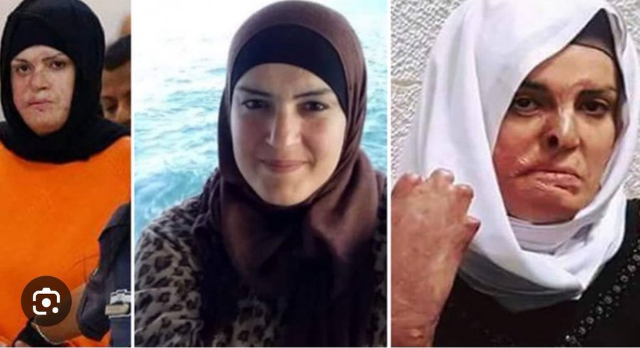 Israa Jaabis yang mengalami luka bakar stadium tiga dalam kecelakaan mobil tahun 2015.