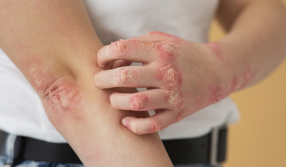 Ilustrasi gejala yang muncul pada tubuh penderita cacar monyet atau mpox.