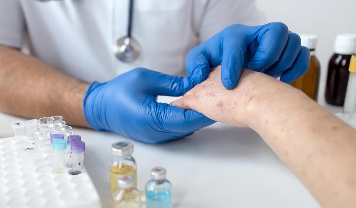 Ilustrasi pasien cacar monyet (Mpox).