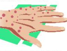 Kasus Mpox Terus Meningkat, Kini sudah 33 Kasus