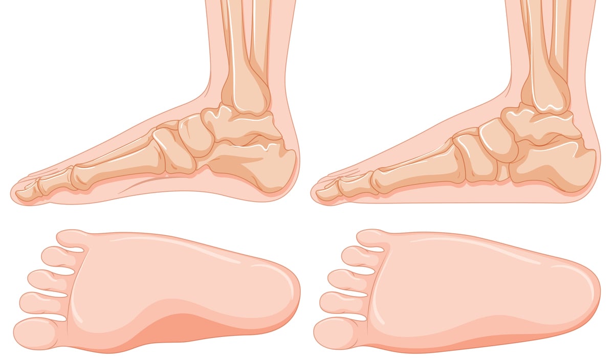 Dokter Sebut Kaki Rata atau Flat Feet pada Anak Hal yang Normal