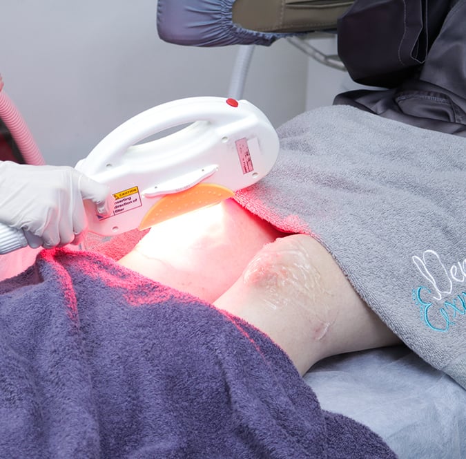 Banyak cara yang dapat dilakukan agar tetap bisa tangani bekas luka membandel.