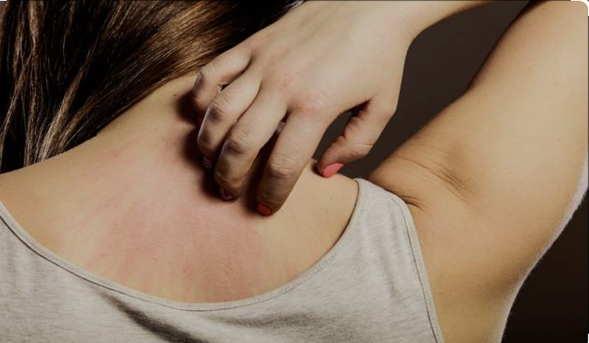 Penyakit Stevens-Johnson