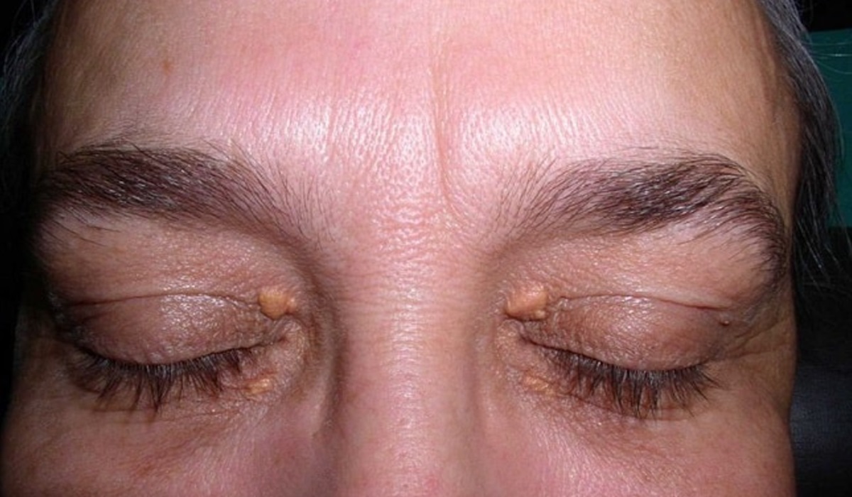 Xanthelasma