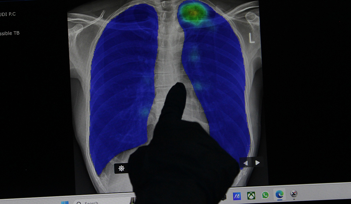 Petugas medis memperlihatkan hasil rontgen paru-paru warga terindikasi Tuberkulosis.