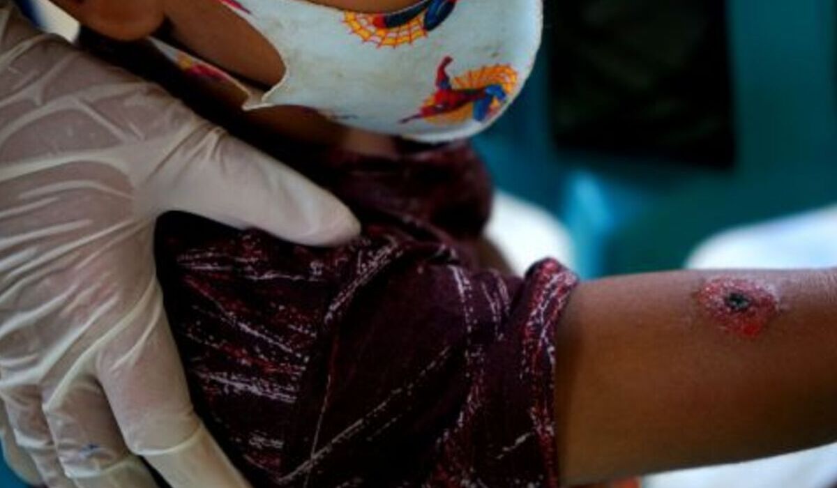 Pasien yang tertular antraks menunjukkan gejala kulit melepuh berbentuk cincin disertai warna gosong di tengah.