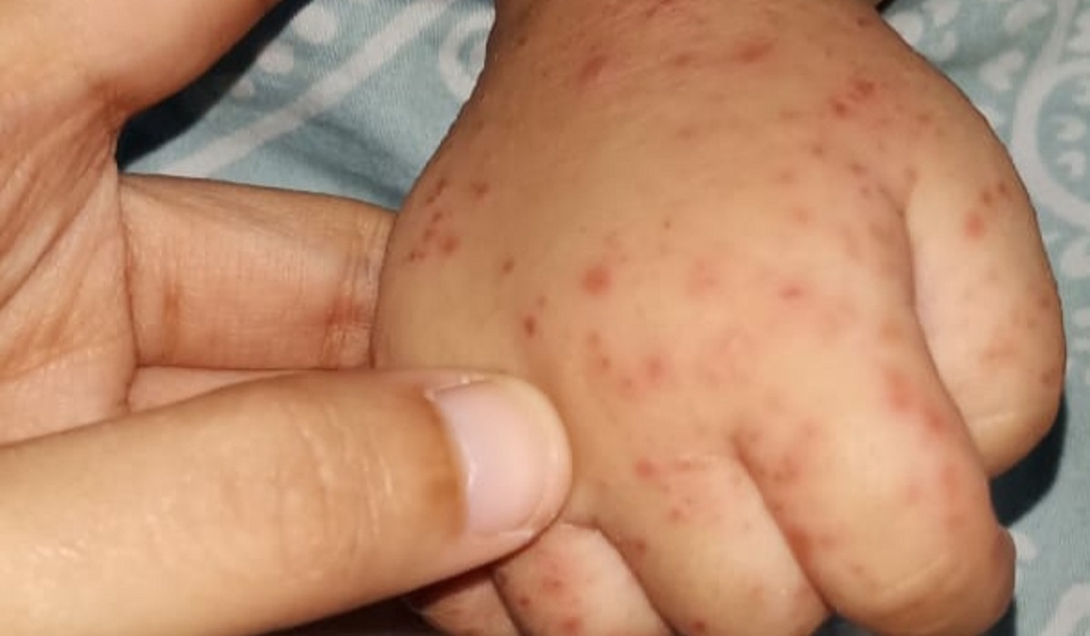Ilustrasi: kondisi tangan bayi yang terserang Flu Singapura