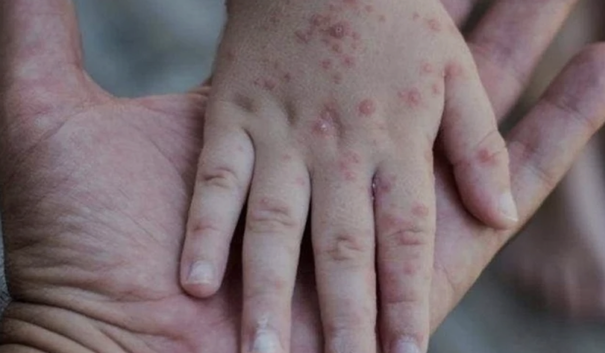 Gejala dqan cara penanganan Flu Singapura