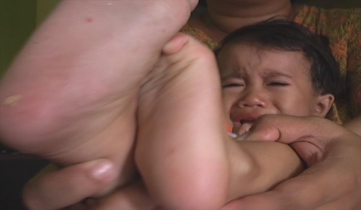 Orangtua memperlihatkan lesi pada telapak kaki anaknya yang menderita Flu Singapura