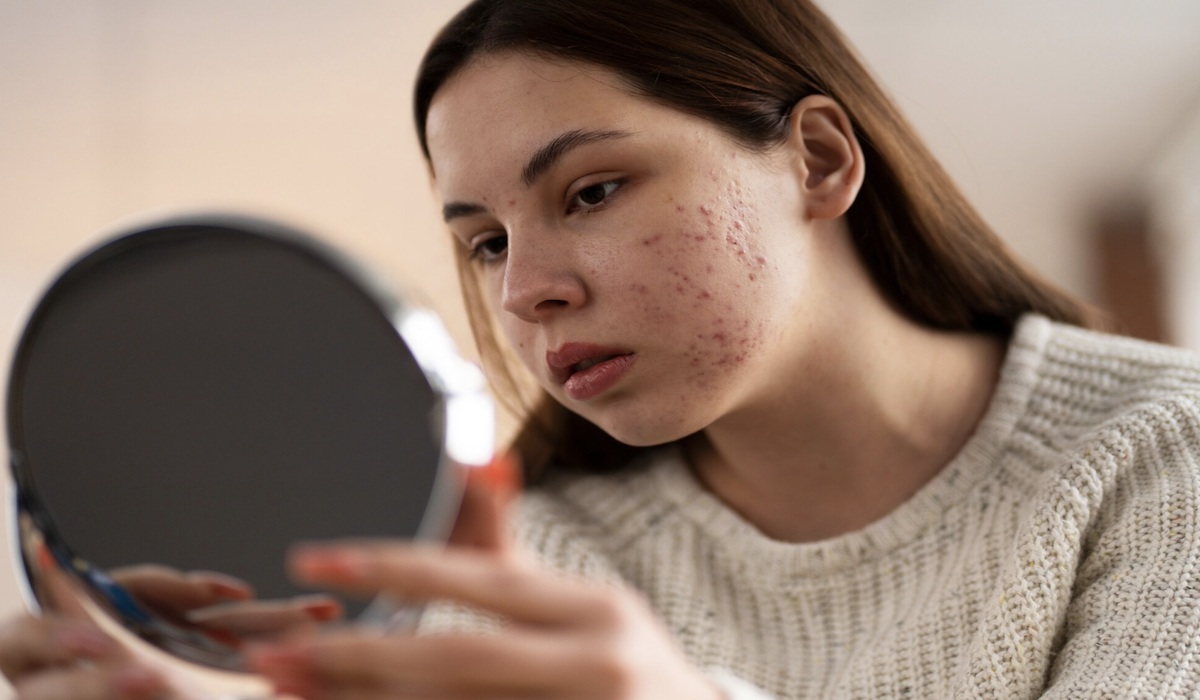 Manfaat kembang turi untuk kesehatan, termasuk mencegah jerawat