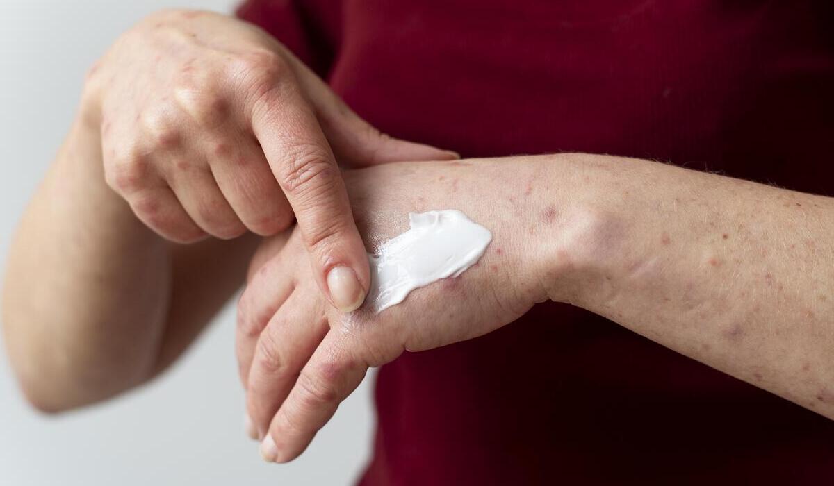 Ilustrasi, kondisi tubuh yang tengah terserang penyakit kulit.