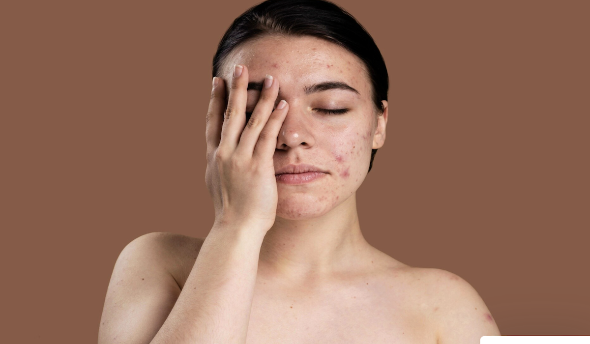 Makanan penyebab jerawat 