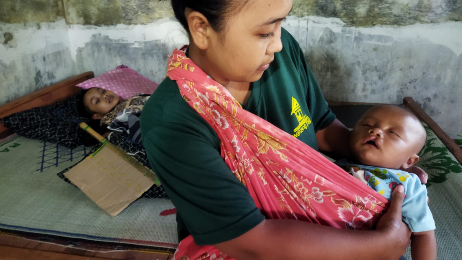 Bayi dengan bibir sumbing