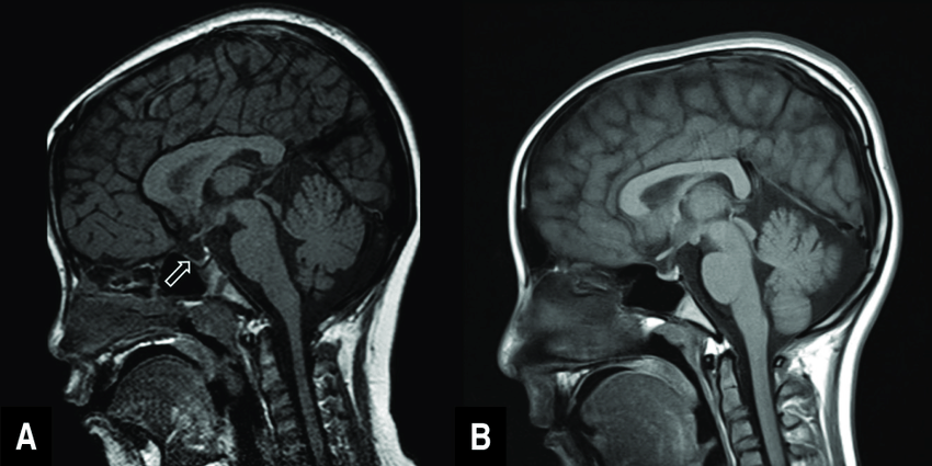 Penyakit Langka, Empty Sella Syndrome Jarang Picu Gejala