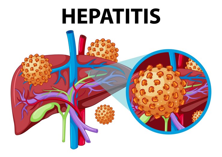 Kenali Gejala Hepatitis A dan Cara Mencegahnya