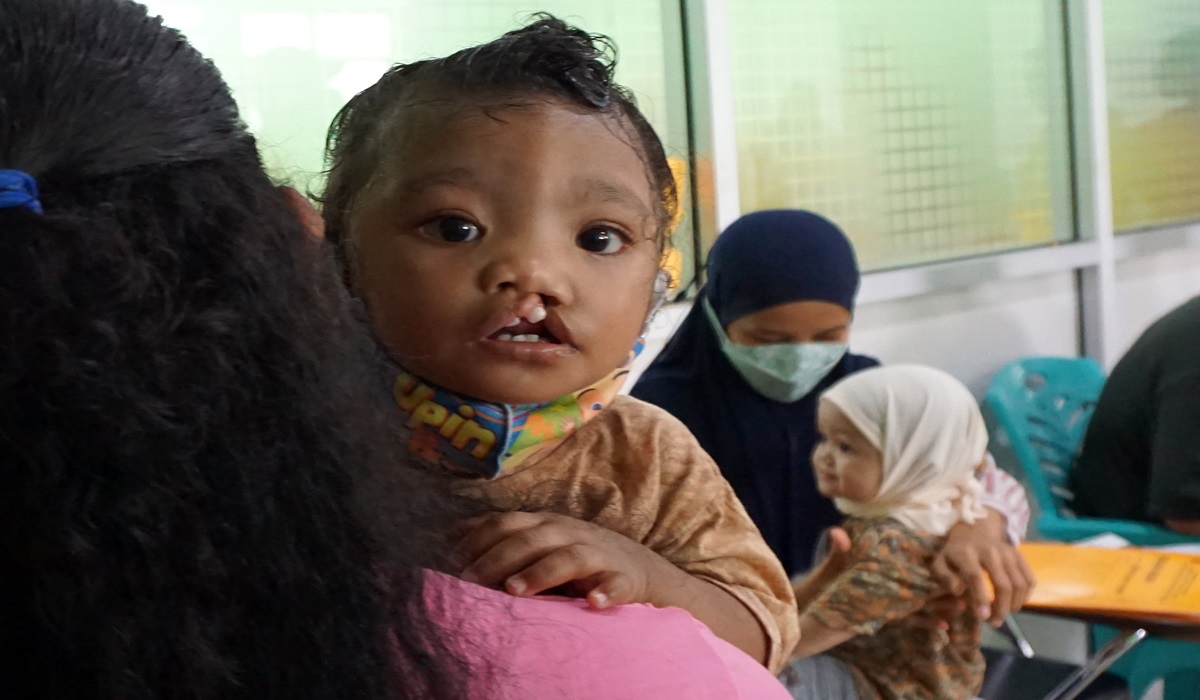 Seorang anak digendong Ibunya antre untuk pemeriksaan kesehatan sebelum pelaksanaan operasi bibir sumbing di Kota Sorong, Papua Barat.