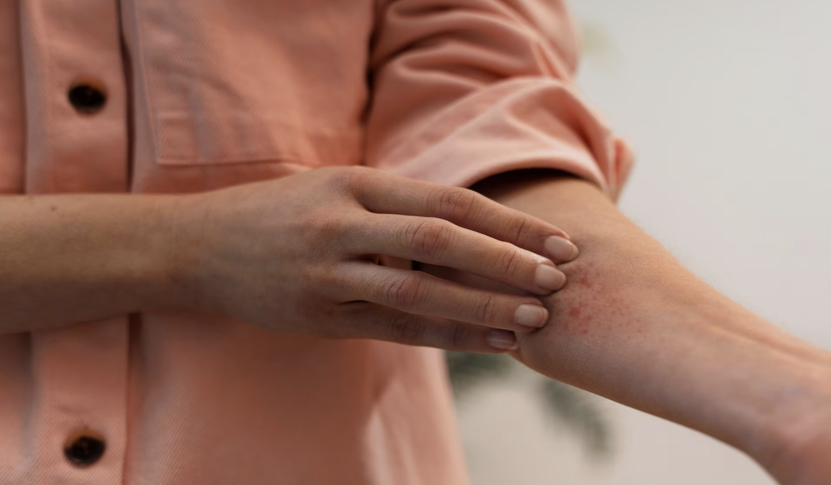 Ini Perbedaan Penyakit Campak dan Alergi, Kamu Sudah Tahu?