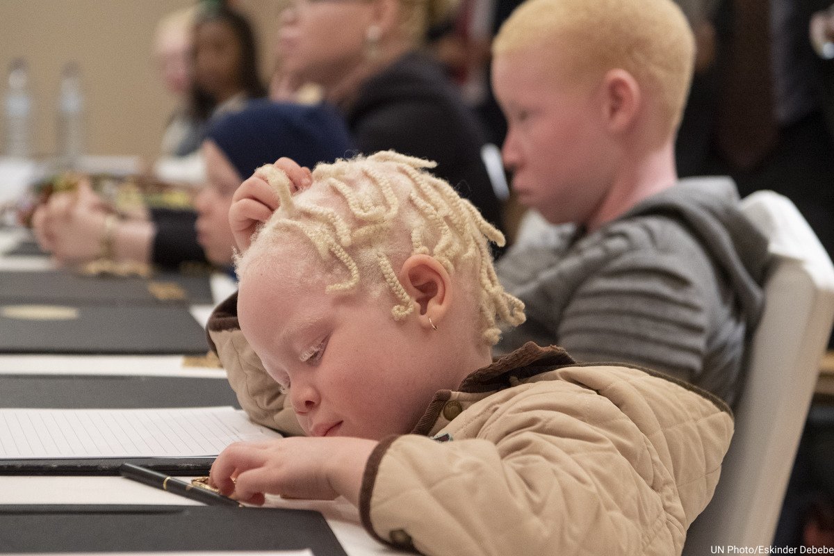 Individu dengan albinisme menghadapi tantangan fisik dan sosial yang signifikan. Ini cara menghormati mereka.