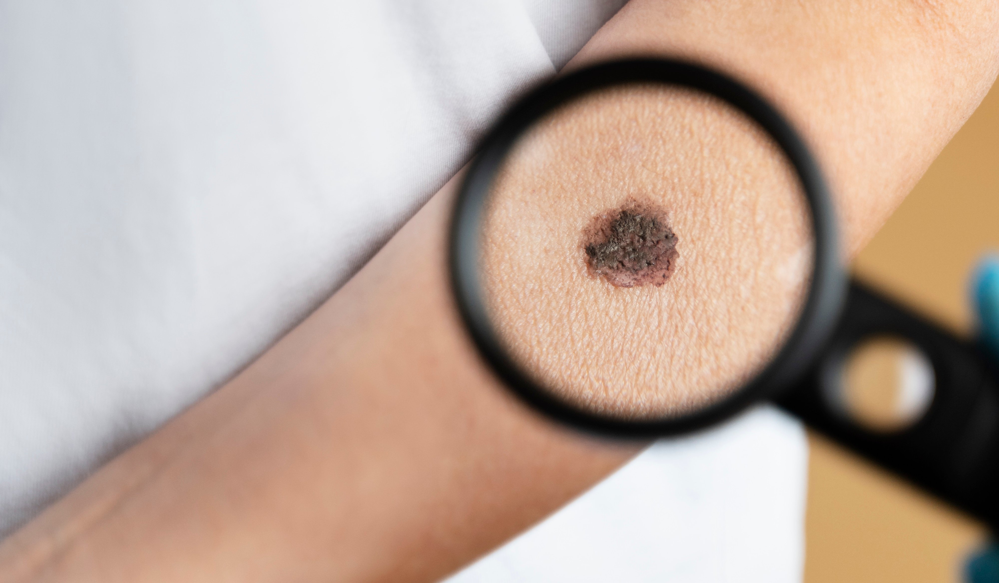Melanoma adalah jenis kanker kulit yang berkembang di sel kulit yang disebut melanosit